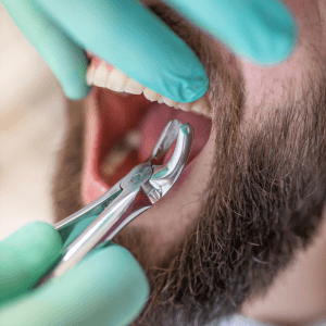 Home Dental Extractions