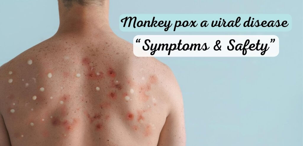 Monkey pox a viral disease &#8220;Symptoms and safety&#8221;