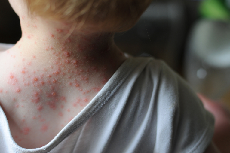 Monkey pox a viral disease &#8220;Symptoms and safety&#8221;