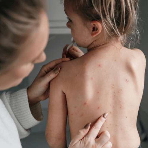 WHO warn&#8217;s About Monkey Pox
